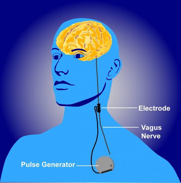 Illustration of vagus nerve stimulation, or VNS Picture