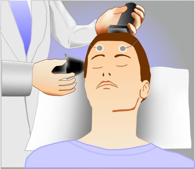 Illustration of electroconvulsive therapy, or ECT Picture