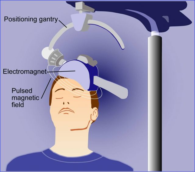 Illustration of transcranial magnetic stimulation, or TMS Picture