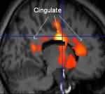 Statistically-analyzed PET scan data superimposed on structural MRI scan (front of brain is at right) shows areas in the anterior and posterior cingul Picture