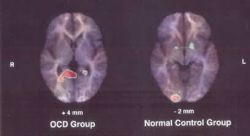 Comparison of normal and OCD brain Image