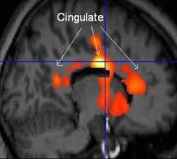 Statistically-analyzed PET scan data superimposed on structural MRI scan front of brain is at right shows areas in the anterior and posterior cingulat Image